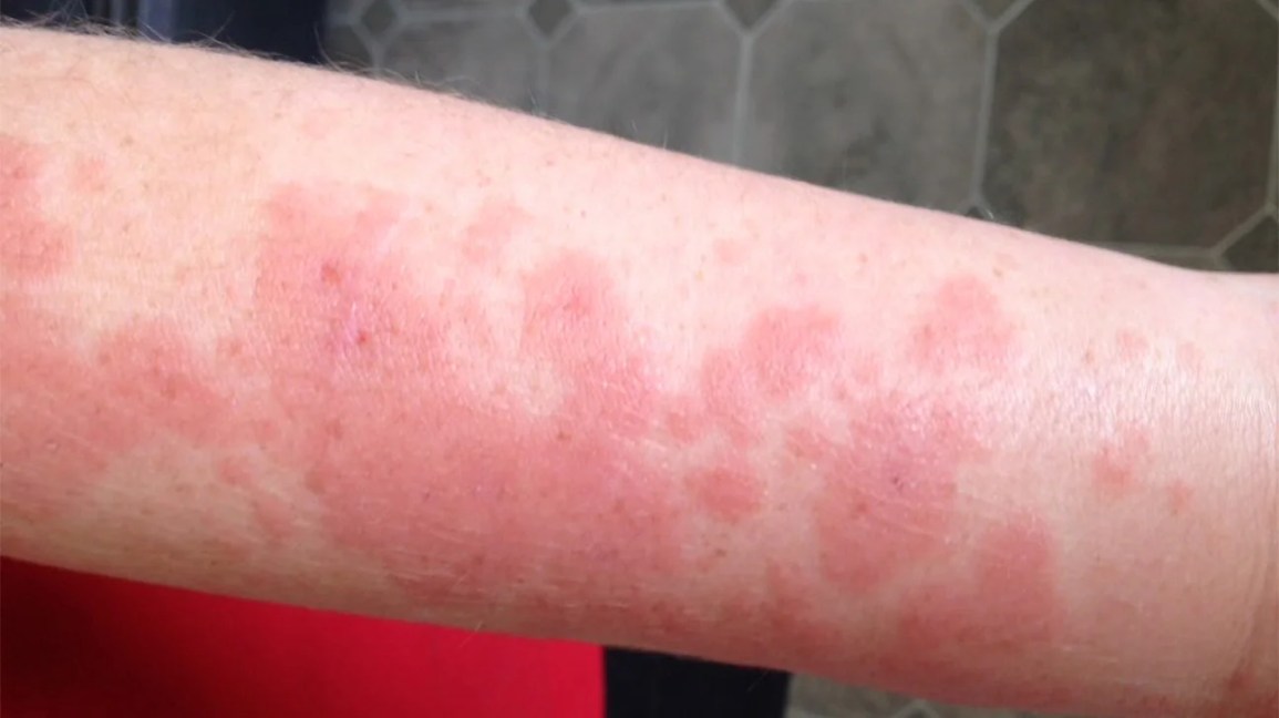 Rash from Sunscreen